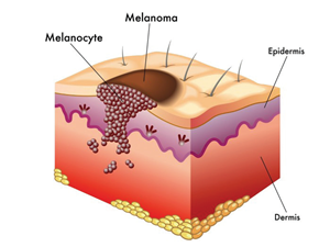 A mole is a natural formation, which can be removed by using Skincell Pro