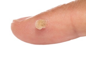 A wart is a skin disease which are effective in fighting the Skincell Pro
