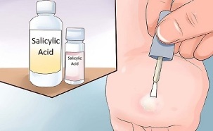 How to get rid of papilloma using folk remedies