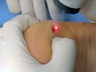 Laser treatment of warts