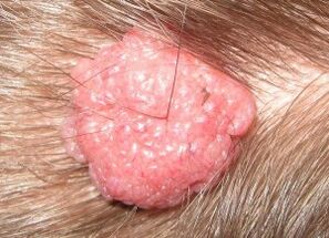 How to get rid of papilloma on the head