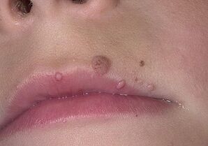 Why do papillomas appear on the lips