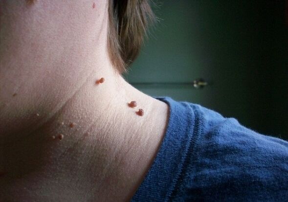 papillomas in the neck