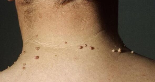 small papillomas on the neck