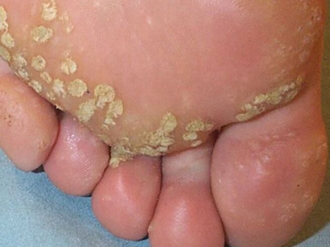 foot warts