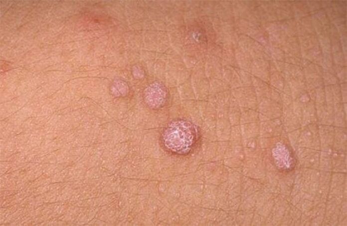 papillomas on human skin