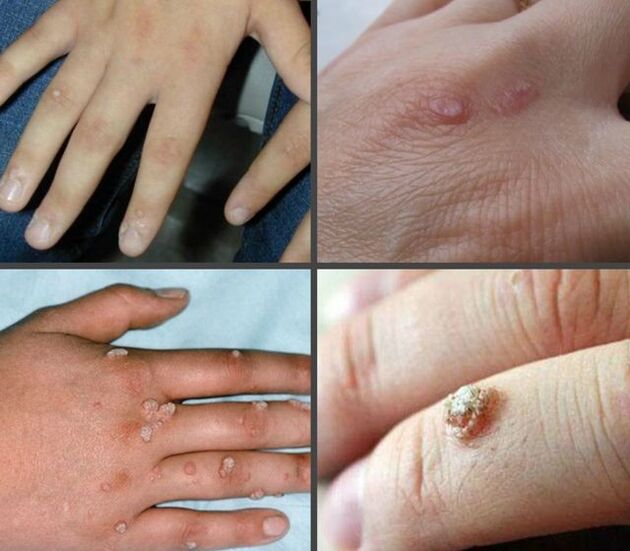 Formation and localization of warts in the hands